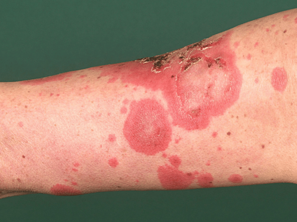 Lupus Erythematodes Grad Der Behinderung www.lupuscheck.de